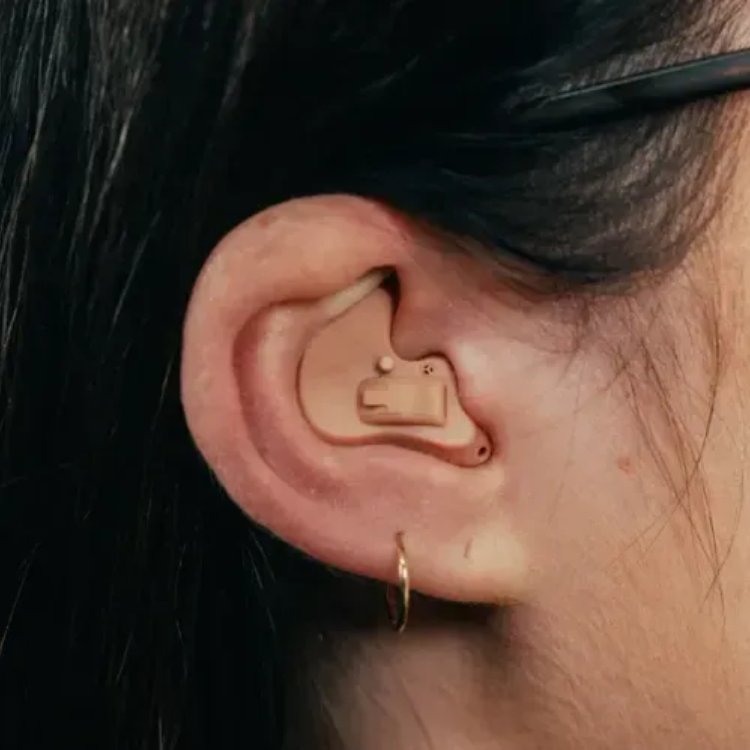 An in-the-ear hearing aid, custom-molded to fill the outer bowl of the ear